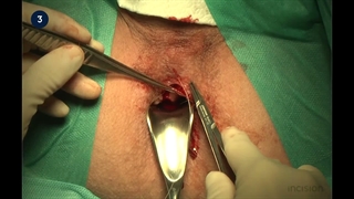 3 Anal Skin Tag Resection