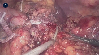 22_2 Laparoscopic Multivisceral Distal Pancreatosplenectomy - Neoplastic