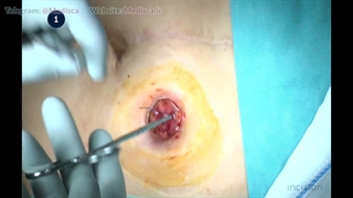 28 Loop Ileostomy Reversal - Stapled