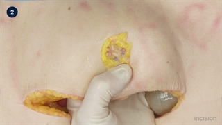 34 Open End Colostomy with Mucous Fistula